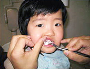 お口の検診と歯のクリーニング